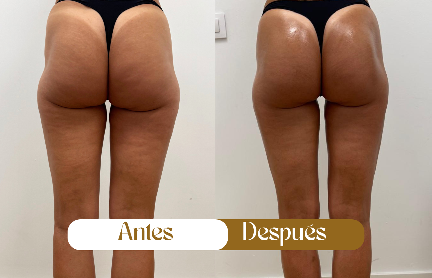 Resultados de radiofrecuencia corporal