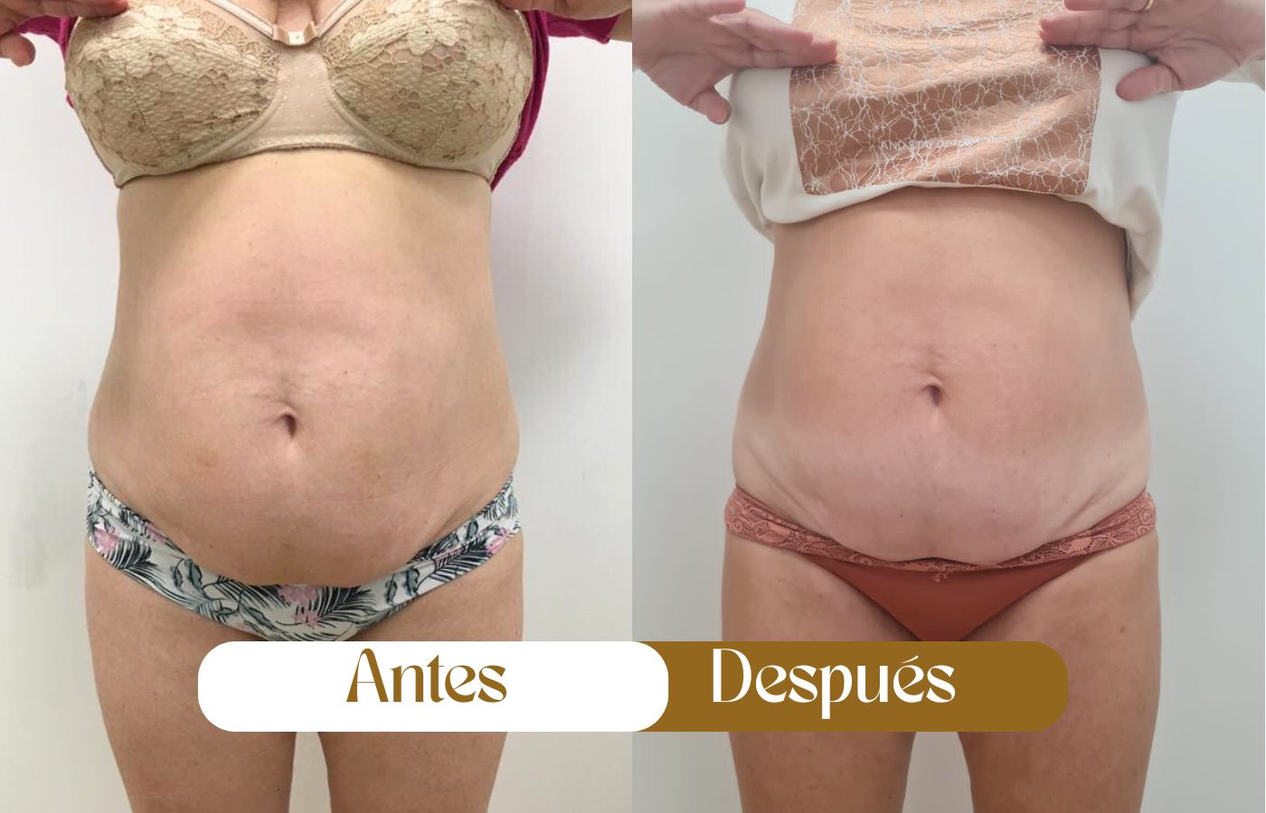 Resultados radiofrecuencia corporal