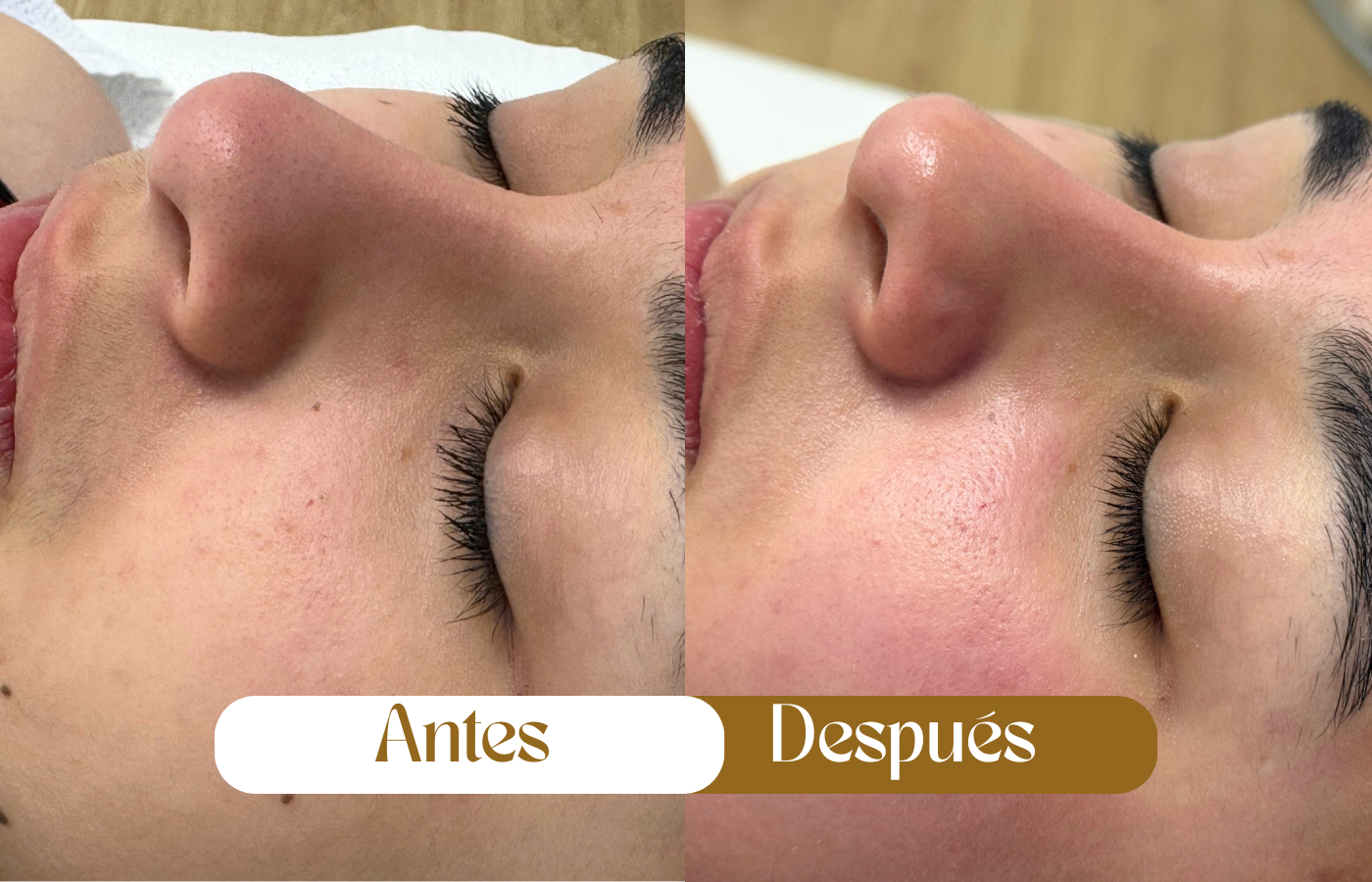 Resultados-limpieza-facial