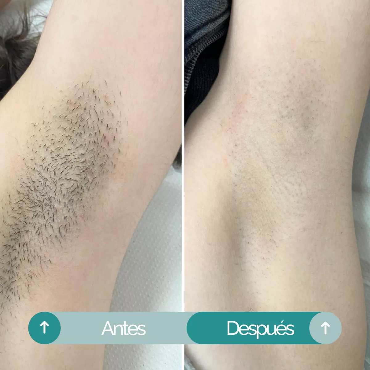 Resultados Depilación láser